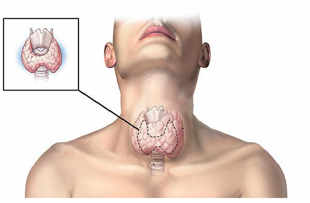 Mức độ nguy hiểm của u tuyến giáp sẽ tùy vào tính chất khối u là lành hay ác tính