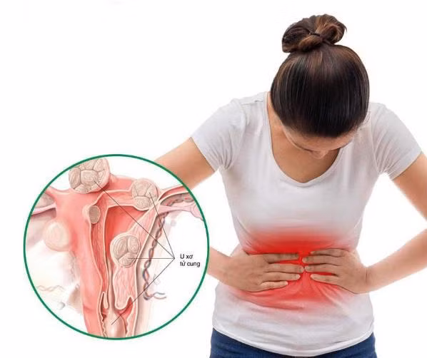 Phẫu thuật u xơ tử cung nếu các triệu chứng bệnh nghiêm trọng
