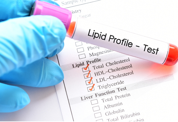 Xét nghiệm mỡ máu cho biết nguy cơ mắc bệnh