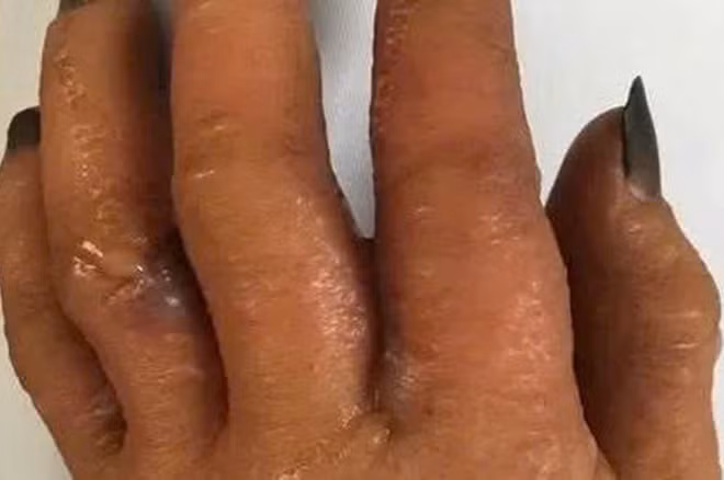 Tự nhuộm tóc tại nhà không đeo găng tay, người đàn ông phải nhập viện 