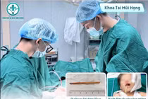 Bé 2 tuổi suýt thủng sọ não vì ngậm đũa khi chơi 