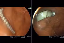Cứu bé 11 tháng tuổi nguy kịch vì nuốt cả đinh vít 4 cm và nhiều dị vật