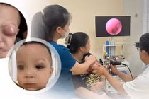Viêm xoang biến chứng áp xe hốc mắt, bé 18 tháng nguy cơ tổn thương thị lực