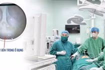 Đau hạ vị kéo dài, người phụ nữ vỡ áp xe phần phụ, mủ tràn ổ bụng