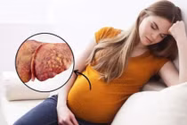 Thay máu toàn cơ thể cứu thai phụ gan nhiễm mỡ cấp tính nặng