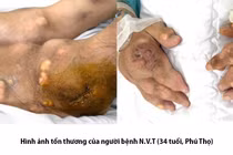 Tự chữa gout, người đàn ông 34 tuổi đối mặt án tử vì nhiễm khuẩn huyết