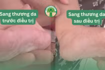 Mẹ mắc giang mai khi mang thai, con nhiễm bệnh dễ viêm não