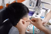 Dị tật tai bẩm sinh, trẻ 12 tuổi bị cholesteatoma đã lan vào xương chũm