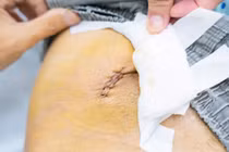 Xơ vữa động mạch chủ, người đàn ông đau bụng mất ăn, mất ngủ