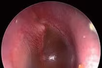 Viêm tai giữa ứ dịch có thể đe dọa thính lực, ngôn ngữ của trẻ