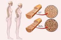 30-40% phụ nữ mãn kinh loãng xương, uống canxi tùy tiện dễ rước thêm nguy cơ
