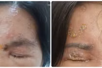 Đối tượng cần tiêm vắc xin Zona tránh biến chứng nặng