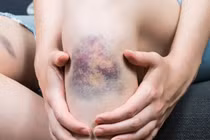 Đừng chủ quan với vết bầm vô cớ ở trẻ, có thể là dấu hiệu bệnh nguy hiểm