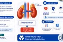U tủy thượng thận gây tăng huyết áp, đột quỵ, nhồi máu cơ tim