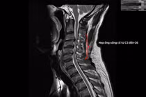 Yếu dần tay trái, người đàn ông 47 tuổi phát hiện chèn ép tủy cổ