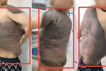 Bé trai mang khối u như mai rùa suốt 7 năm lần đầu đứng thẳng