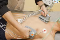 Sốc điện chuyển nhịp giúp người phụ nữ tránh đột quỵ sau 20 năm mổ tim