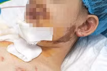 Nhiều trẻ nguy kịch vì tai nạn thương tích ngày hè