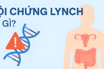 Nhiều người mắc ung thư trong cùng gia đình, đừng bỏ qua hội chứng Lynch