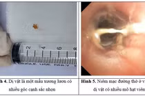 Dị vật 'bị bỏ quên' hơn 1 tháng trong phế quản bé trai 3 tuổi 