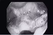 Sau bữa ăn, cụ ông 87 tuổi hóc nguyên hàm răng giả dài 7 cm