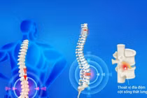 Đau lưng, tê chân kéo dài: Đừng chủ quan, đừng cố tập khi đau tăng