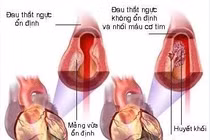 Đau thắt ngực theo chu kỳ có phải tổn thương động mạch vành?