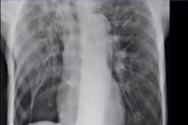 COPD khó thở bất thường, cụ ông 71 tuổi suy hô hấp vì tràn khí màng phổi