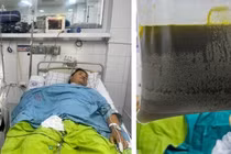 Thoát khỏi cơn nguy kịch do suy gan cấp nhờ kỹ thuật tách huyết tương 
