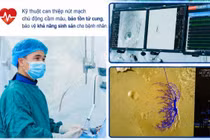 Ra máu kéo dài sau đình chỉ thai, người phụ nữ được cứu nhờ nút mạch