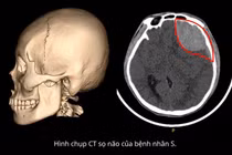 Tỉnh táo sau tai nạn, hai thanh niên nguy kịch vì chấn thương sọ não 