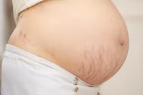 Bác sĩ mách cách điều trị rạn da sau sinh