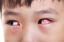 Bộ Y tế cảnh báo đau mắt đỏ gia tăng, nguy cơ lây nhiễm tại bể bơi