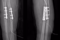 Ngã xe đạp trẻ 7 tuổi suýt mất vận động vì gãy kín