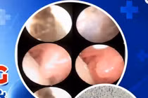 Ca bệnh cực hiếm: Bé sơ sinh mang mô thần kinh 'đi lạc; trong mũi họng 