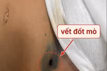 Sốt 5 ngày, bé gái 2 tuổi rơi vào sốc nhiễm khuẩn vì căn bệnh dễ bỏ sót