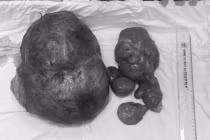 Dùng thuốc Nam điều trị 6 tháng, u ổ bụng phát triển gần 8kg 
