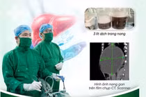 Hút hơn 3 lít dịch từ nang gan lành tính