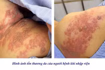 Mắc zona đau đầu dữ dội, cảnh giác biến chứng hệ thần kinh, viêm màng não
