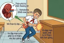 Bé trai 7 tuổi vỡ thận sau cú ngã khi nô đùa trong lớp học