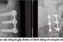 Phẫu thuật thành công cho bệnh nhân gãy đốt sống thắt lưng ở Quảng Trị