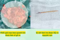 Hy hữu: Mổ cấp cứu tràn mủ màng tim, phát hiện tăm tre xuyên thất phải