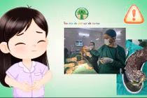 Đau bụng âm ỉ tái diễn, trẻ 5 tuổi bị búi tóc lớn “đúc khuôn” trong dạ dày