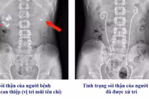 16 tuổi suy thận cấp vì sỏi thận – niệu quản phức tạp