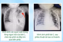 Ruột chui lên lồng ngực vì dị tật bẩm sinh, bé 17 tháng tuổi ho kéo dài