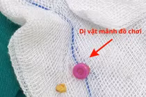 Trẻ 3 tuổi có 2 dị vật trong tai, gia đình không hề hay biết
