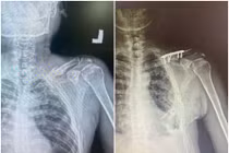 Ngã gãy nhiều xương sườn, xương đòn, người đàn ông được cứu bằng một thì mổ