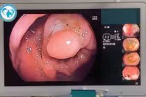 Viêm loét đại trực tràng chảy máu kèm đa polyp ở người đàn ông 49 tuổi