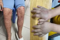 Nhiều trẻ bị ban xuất huyết biến chứng thận nguy hiểm 