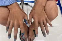 Cả gia đình cùng ngứa, 18 tuổi bị ghẻ bội nhiễm nặng